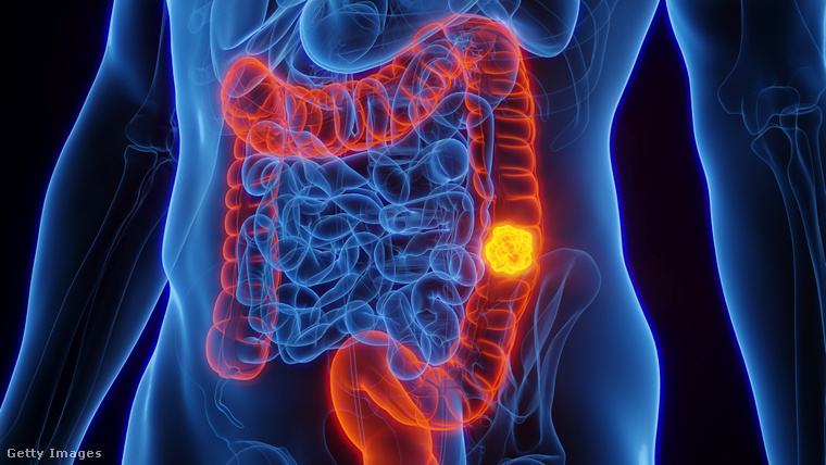 A vastagbélrák korai tünetei közé tartozik a hasi fájdalom és a puffadás is. (Illusztráció: Getty Images)