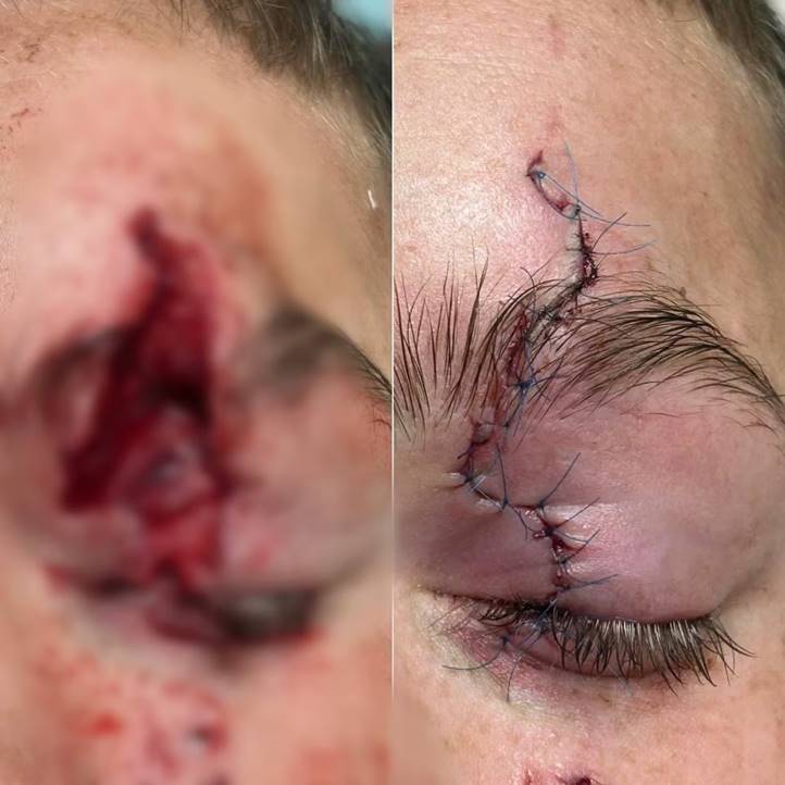 Kárpátalján egy 13 éves fiú majdnem elveszítette a szemét, fejszével játszott. Fotó: Mukachevo.net