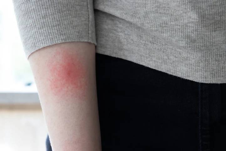 A kokárda-szerű Lyme-folt az egyik legárulkodóbb jel, de nem mindenkinél alakul ki.  Fotó: Shutterstock /  