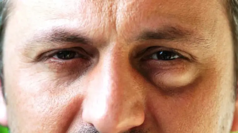 Táskás szem: mi okozza?