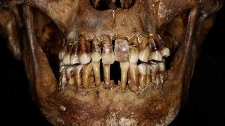 Ijesztő titka volt a 17. századi arisztokratának a fogai megőrzésére