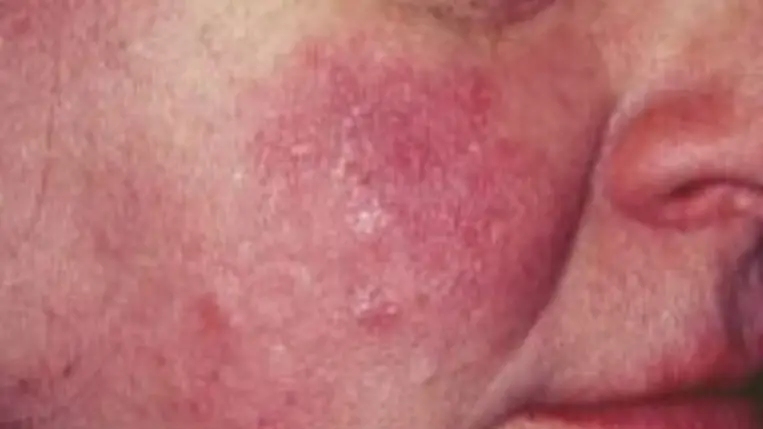 Nem csak a fűtött szoba, betegség miatt is kipirosodhat az arc