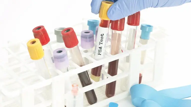 Több mint 50 ráktípust kimutató vérvizsgálatot teszteltek biztató eredményekkel