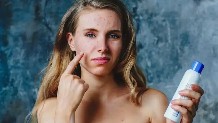  Van 5 népszerű étel, ami pattanásokat és ráncokat okoz 