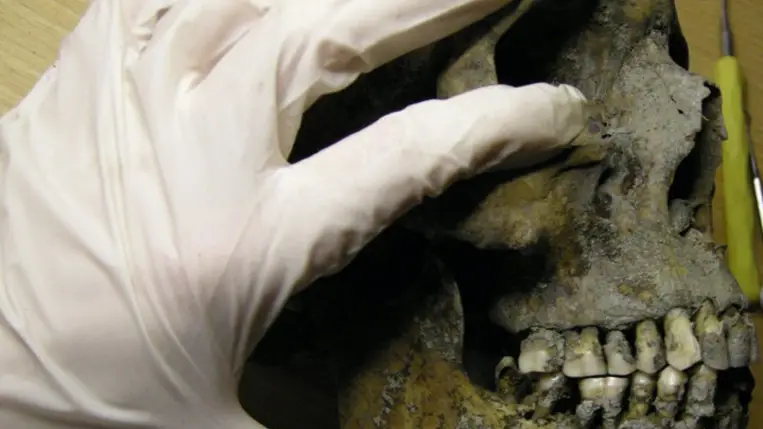 A vikingek fogromlástól szenvedtek 