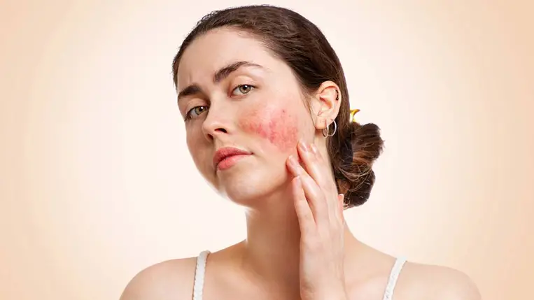 Hogyan ápold a bőröd rosacea esetén, és mi az, ami szigorúan tilos?