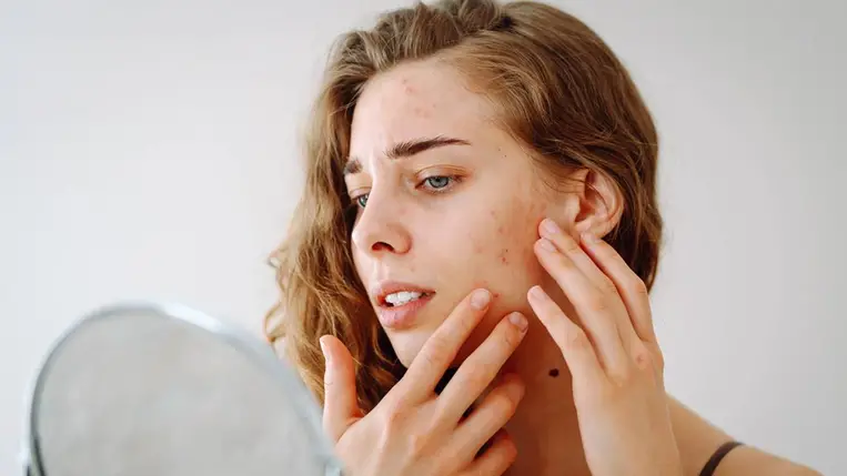 7 étel, ami berobbantja az aknét - A legtöbbet naponta eszed