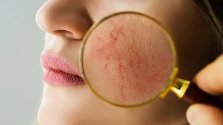 7 ok, ami az arcon megjelenő pókhálóerek mögött állhat