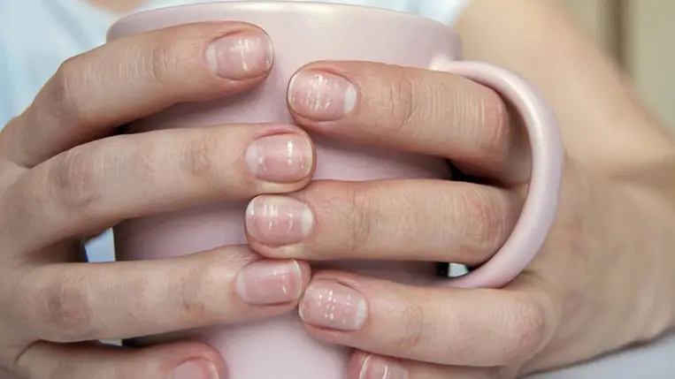 Betegséget jelezhet, ha ezt látod a körmödön