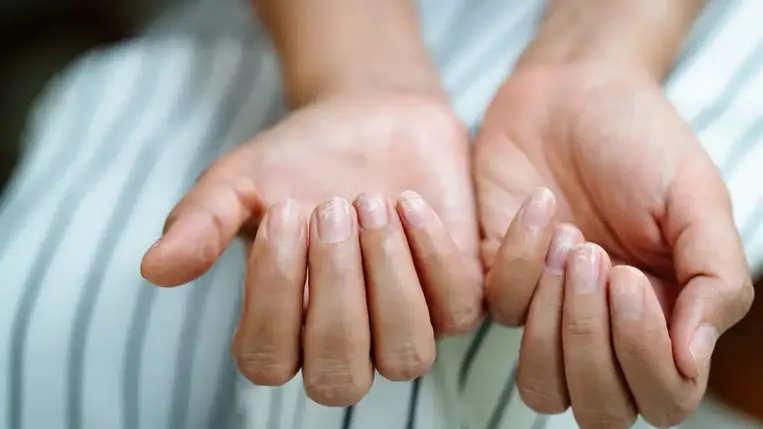 10 tünet és betegség, mely a körmök egészségtelen állapotára hívja fel a figyelmet 
