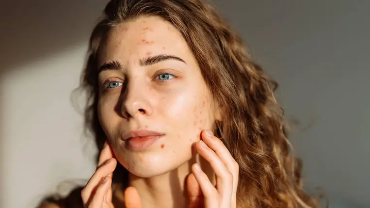 5 mindennapi szokás, ami gyulladásokat okoz a bőrön