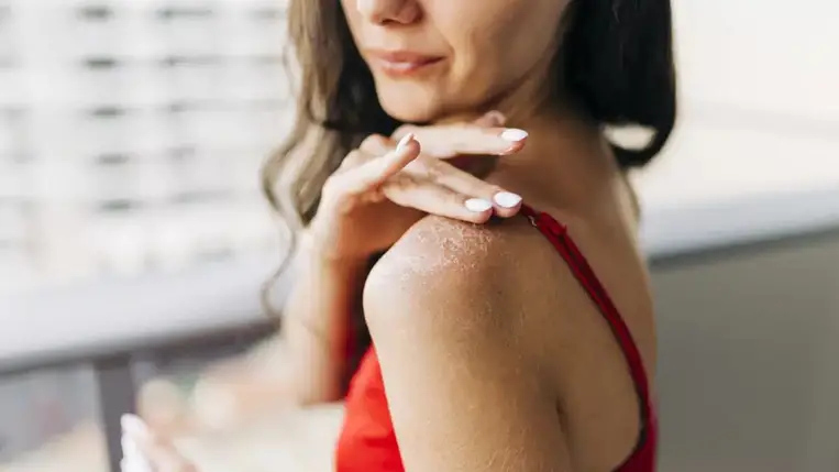 5 természetes SOS megoldás napégésre 