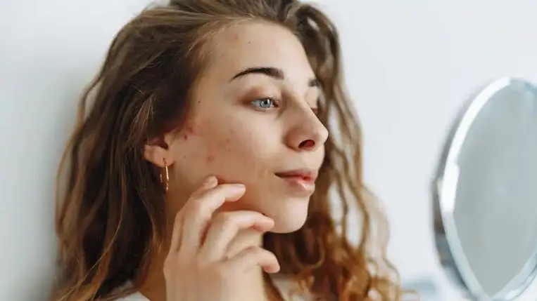 Erről árulkodhatnak az arcodon megjelenő aknék és pattanások 