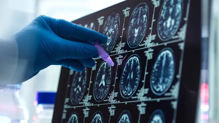 Ezzel a pofonegyszerű módszerrel megelőzhető az Alzheimer-kór 