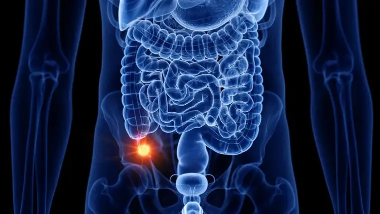 Gyorsan terjed és a fiatalokat vette célba egy alig ismert ráktípus 