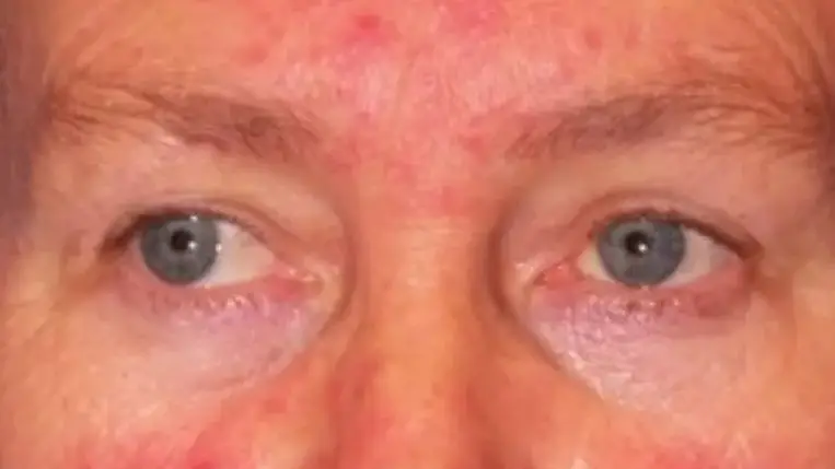 Kipirosodott az orra a tavaszi naptól? Ha rozácea, fontos a kezelés! 