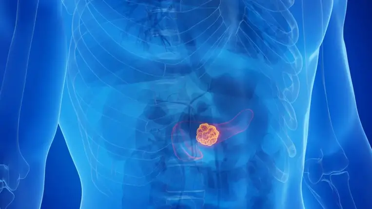 Kitálaltak a tudósok: ez a rejtett tényező teszi igazán halálossá a hasnyálmirigyrákot
