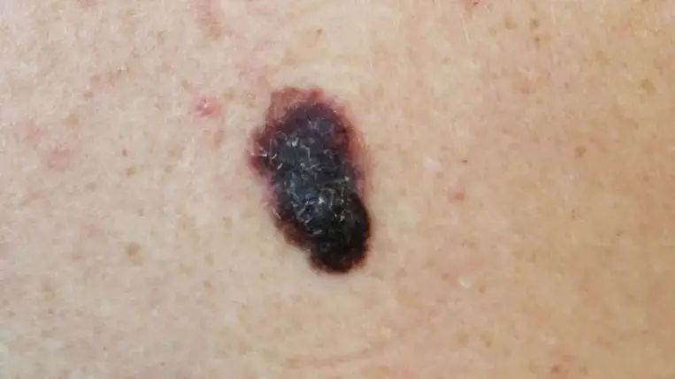 Megváltoztathatja a napfény az anyajegyet? 