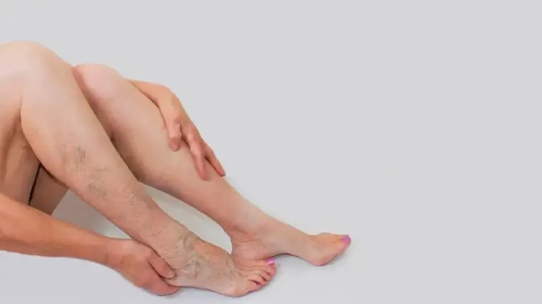 Mit tehetnek önmagukért a visszérbetegek a kánikulában? 