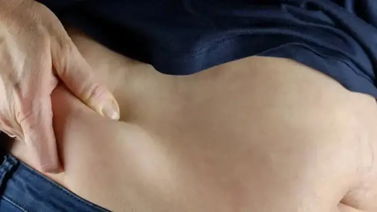 Veszélyes lehet, ha túl gyorsan szeretne strandformát 