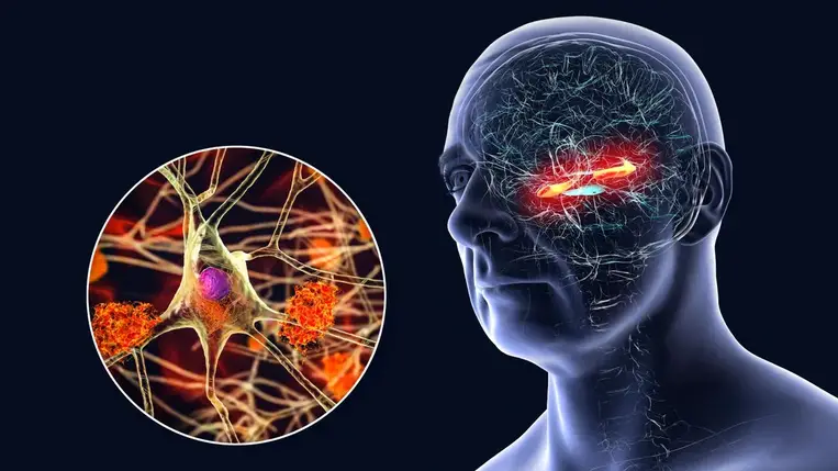 Megvan az Alzheimer-kór ellenszere? Jól ismert gyógyszer jelentheti a megoldást