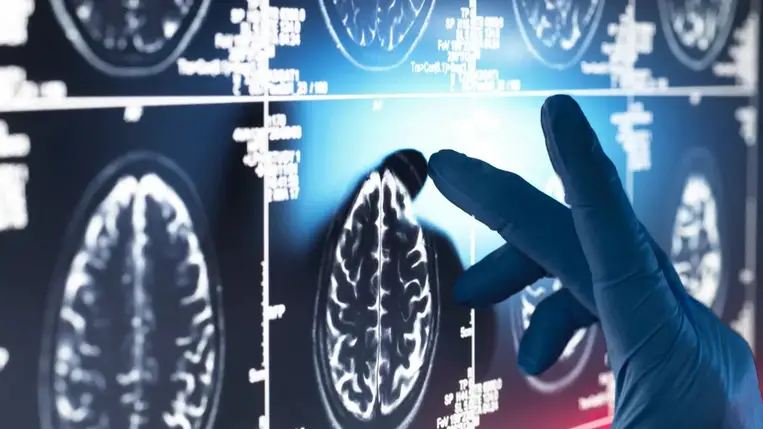 Olyan dolgot találtak az Alzheimer-kóros agyban, amire még a tudósok sem számítottak