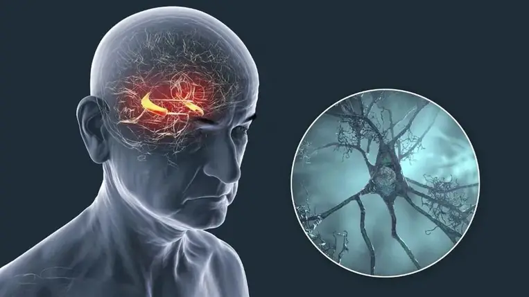 Miért ellenálló egyes emberek agya az Alzheimer-kórral szemben?