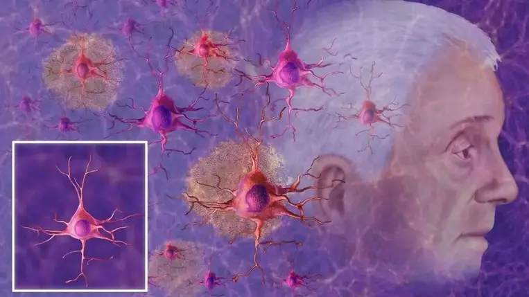 Bűzös megoldás az Alzheimer-kór ellen
