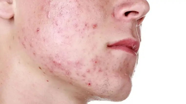 Mindent próbált, de nem múlnak a pattanások? A bőratkakezelés segíthet