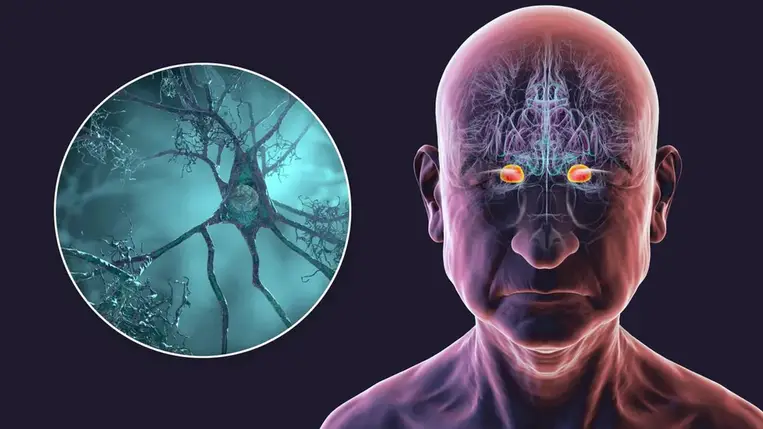 Rémisztő magyarázatot találtak az egyre gyorsabban terjedő demencia okára