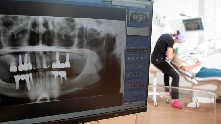 Soha többé implantátum? Hatalmas fordulat jöhet a fogászatban