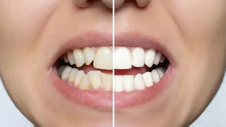 Otthoni megoldások fogfehérítésre – mi az, ami tényleg működik?