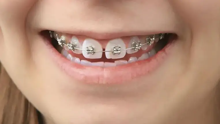 Itt a meglepő magyarázat, miért van szüksége sok embernek fogszabályzóra