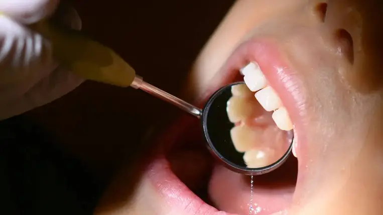 Fluoridmentes gél segítheti a sérült fogzománc helyreállítását