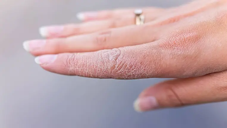 Ha te is ezt látod a kezeden, brutális vitaminhiányod lehet