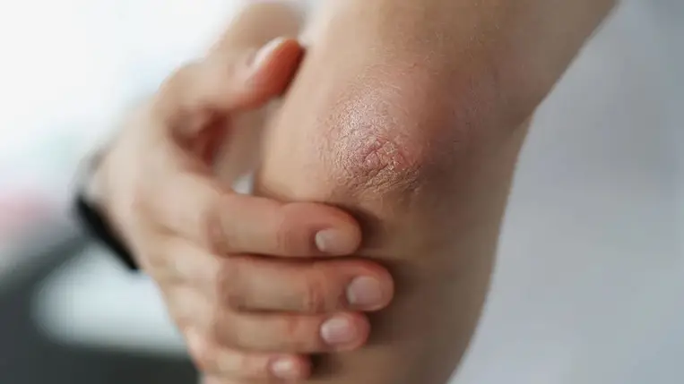 A sötét és érdes könyökért nem a kosz a felelős – ez állhat a háttérben