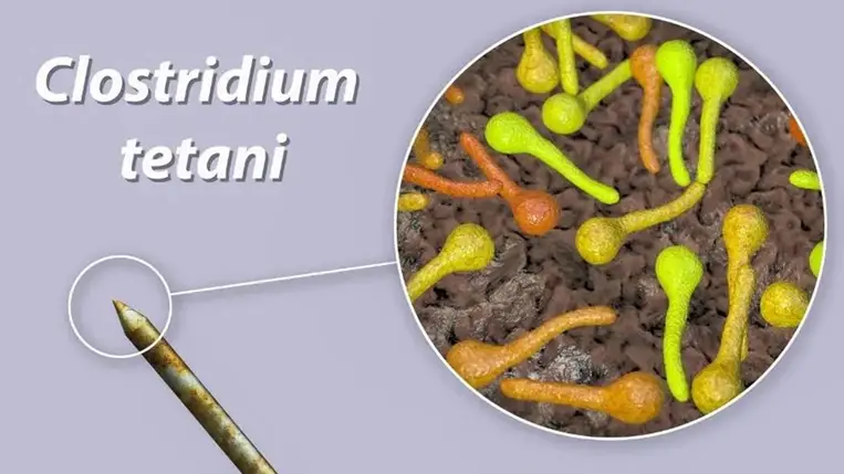 Sok minden téves, amit a tetanuszról tudni véltünk