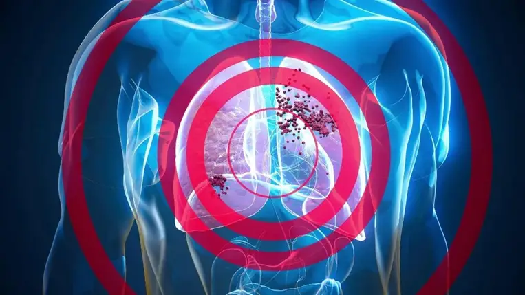 Ez a két hétköznapi betegség megnöveli a tüdőrák későbbi kockázatát