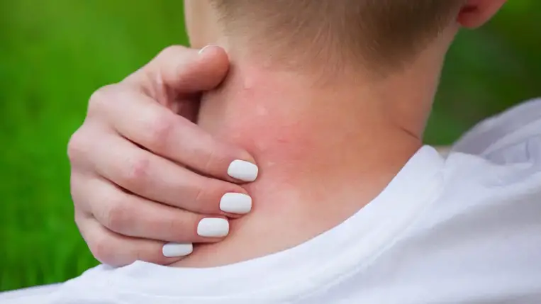 Csípésre fokhagyma! 5 hatásos házi módszer a szúnyogcsípés enyhítésére 