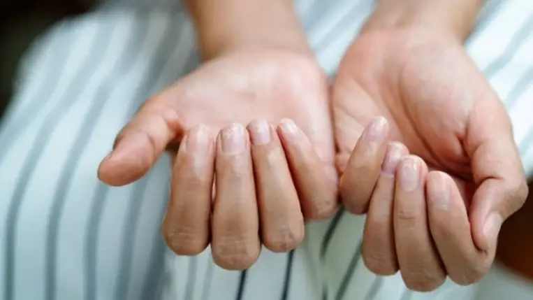 A töredezett körmök leggyakoribb okai