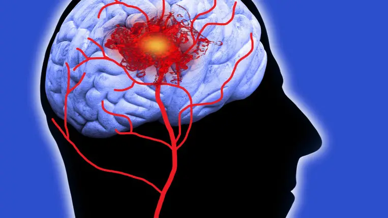 Stroke: ez a vércsoport van a legnagyobb veszélyben