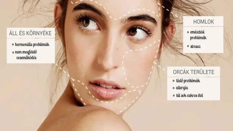  Hol bújt ki a pattanásod? Ezt árulja el az egészségedről 