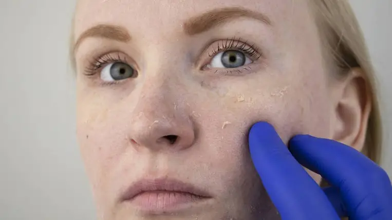 8 intő jel a bőrön, ami D-vitamin hiányra utal tél végén