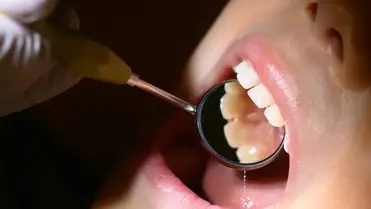 Fluoridmentes gél segítheti a sérült fogzománc helyreállítását