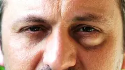 Táskás szem: mi okozza?