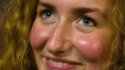 Váratlan baj jele lehet az arcpír