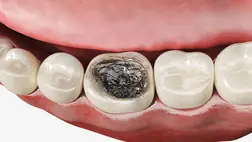 A bronzkori gyerekek csak hírből ismerték a fogszuvasodást