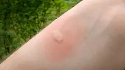 Darázscsípés. Illusztráció. Fotó: internet