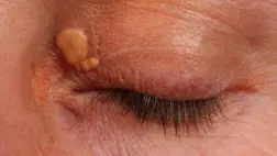 Így mutatja meg a bőr, ha magas a koleszterinszint - Kevesen ismerik fel a tüneteket