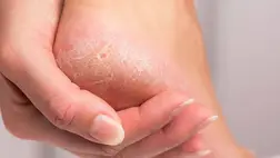 Eltűnik a bőrkeményedés és a tyúkszem, babapuha lesz a bőr